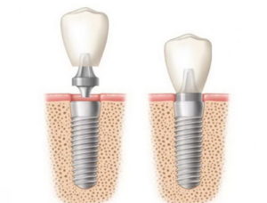 Сколько можно вернуть за имплантацию зубов? Можно вернуть 13 процентов от стоимости лечения, но с некоторыми ограничениями
